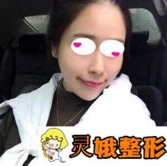 兰州大学第二医院整形科假体垫下巴案例