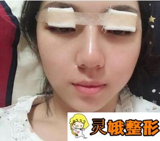 洛阳班大夫整形双眼皮案例