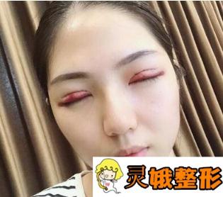 洛阳班大夫整形双眼皮案例