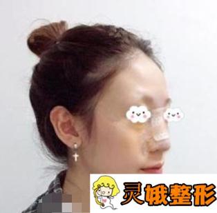 沈阳202医院整形美容科隆鼻案例