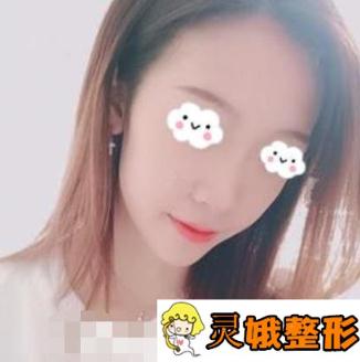 沈阳202医院整形美容科隆鼻案例