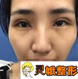 沧州二医院美容整形科双眼皮案例