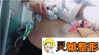河南一科整形美容医院价格表详细对比一览，附抽脂瘦身案例