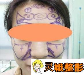  解放军452医院整形科价格表隆重发布，另附面部吸脂案例图