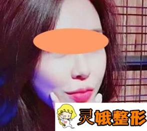  解放军452医院整形科价格表隆重发布，另附面部吸脂案例图