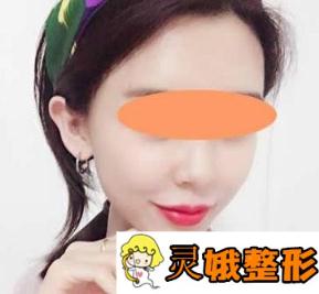  解放军452医院整形科价格表隆重发布，另附面部吸脂案例图
