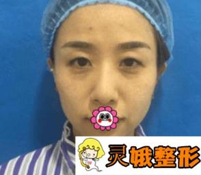 石家庄260医院整形美容科好吗？价格表+双眼皮手术恢复图片
