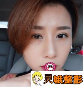 石家庄260医院整形美容科好吗？价格表+双眼皮手术恢复图片