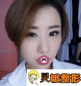 石家庄260医院整形美容科好吗？价格表+双眼皮手术恢复图片