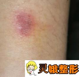 德州市第二人民医院美容整形科价格表及疤痕修复果图公布