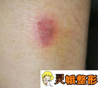 德州市第二人民医院美容整形科价格表及疤痕修复果图公布