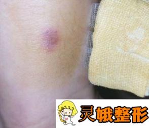 德州市第二人民医院美容整形科价格表及疤痕修复果图公布