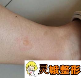 德州市第二人民医院美容整形科价格表及疤痕修复果图公布