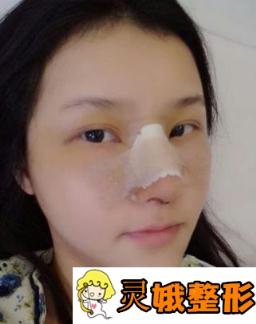 佛山顺德艺美整形价格表上线，附隆鼻日记