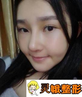 佛山顺德艺美整形价格表上线，附隆鼻日记