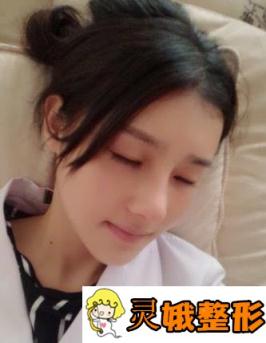 佛山顺德艺美整形价格表上线，附隆鼻日记