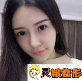 佛山顺德艺美整形价格表上线，附隆鼻日记