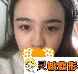 广州粤美整形医院价格表抢先一看，附隆鼻手术分享