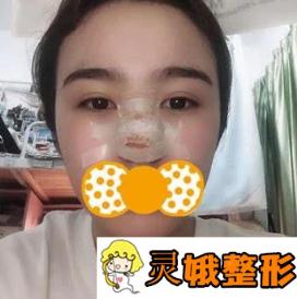 广州粤美整形医院价格表抢先一看，附隆鼻手术分享