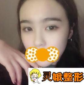 广州粤美整形医院价格表抢先一看，附隆鼻手术分享