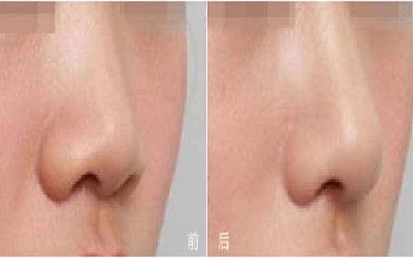 衡阳雅美医疗美容医院怎么样?附案例