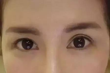 大连中心医院美容部王林美丽双眼皮案例