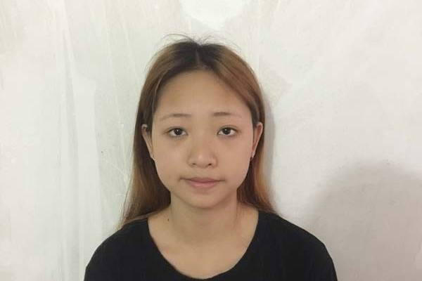 福州省立医院整形外科面部吸脂案例