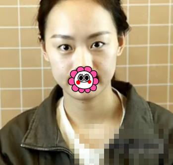 冯传波医生双眼皮案例，漂亮双眼