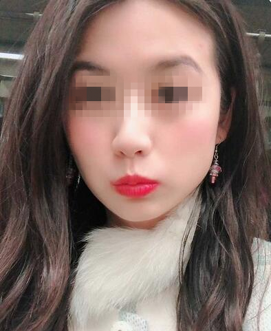 彩光嫩肤术后1-10天果对比