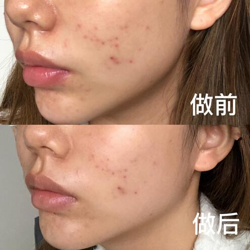 光子嫩肤调节痘印案例分享