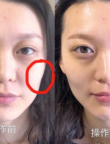 深圳非凡整形医院电波拉皮除皱真人案例