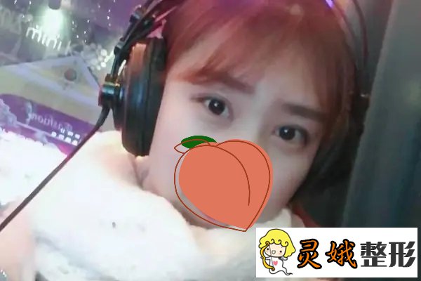 北京开内眼角手术怎么样？真人手术案例来喽！