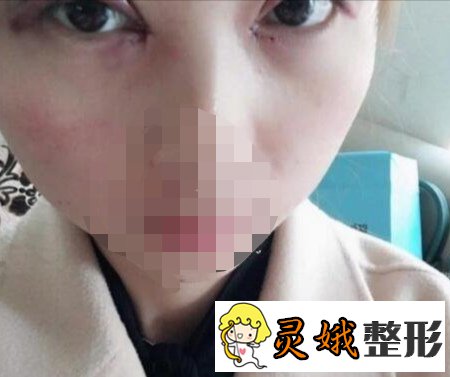 北京开内眼角手术怎么样？真人手术案例来喽！