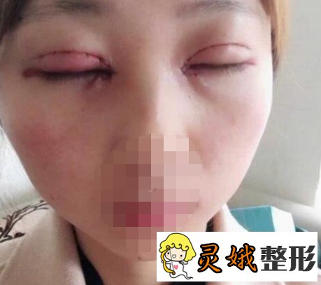 北京开内眼角手术怎么样？真人手术案例来喽！