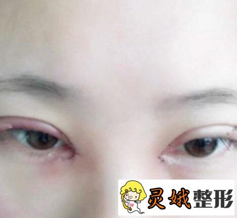 北京开内眼角手术怎么样？真人手术案例来喽！