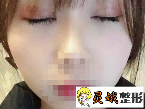 北京开内眼角手术怎么样？真人手术案例来喽！