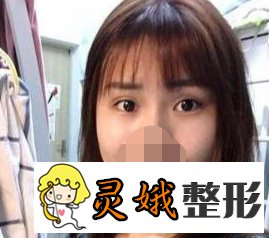 【案例】北京开外眼角手术果真是好，真人果图来喽！