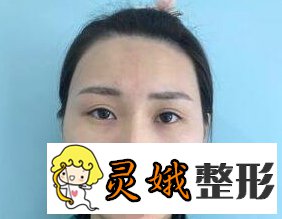 【案例】北京开外眼角手术果真是好，真人果图来喽！