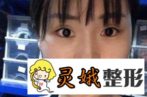 【案例】北京开外眼角手术果真是好，真人果图来喽！