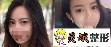 【案例】光乳化去眼袋果怎么样？原来去眼袋手术可以这样做啊！