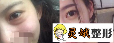 【案例】光乳化去眼袋果怎么样？原来去眼袋手术可以这样做啊！