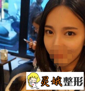【案例】光乳化去眼袋果怎么样？原来去眼袋手术可以这样做啊！