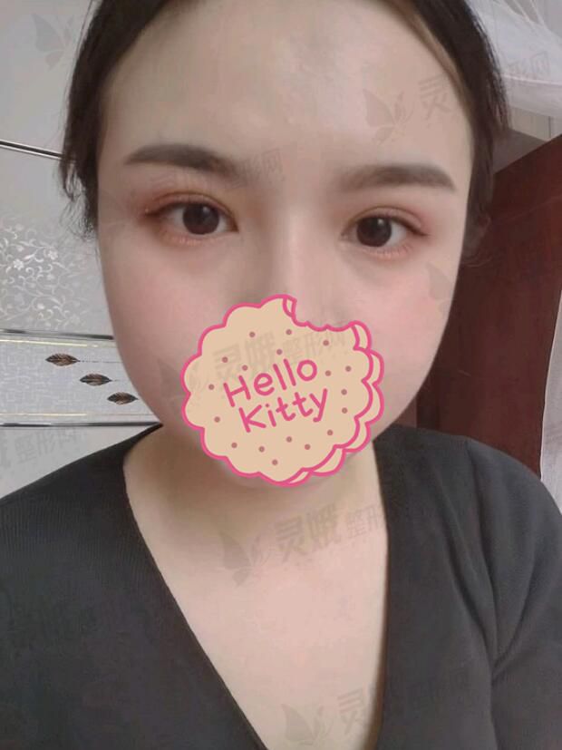 杭州格莱美医疗美容医院双眼皮果图
