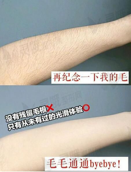 光子脱毛果图