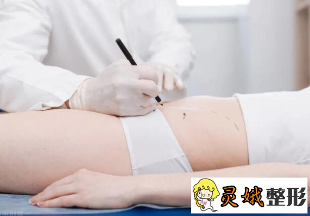 吸脂手术后遗症有哪些？【上海九院吸脂医生推荐列表】吸脂案例展示