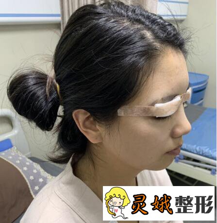 深圳阳光医院双眼皮之深圳阳光双眼皮案例,在梦里笑过的人