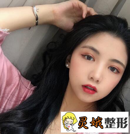 深圳阳光医院双眼皮之深圳阳光双眼皮案例,在梦里笑过的人