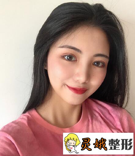 深圳阳光医院双眼皮之深圳阳光双眼皮案例,在梦里笑过的人