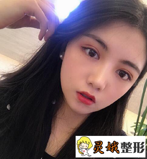 深圳阳光医院双眼皮之深圳阳光双眼皮案例,在梦里笑过的人