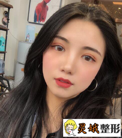 深圳阳光医院双眼皮之深圳阳光双眼皮案例,在梦里笑过的人